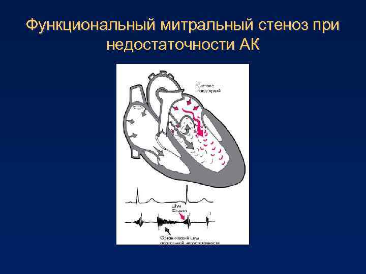 Функциональный митральный стеноз при недостаточности АК 