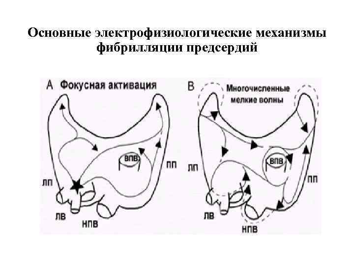 Основные электрофизиологические механизмы фибрилляции предсердий 