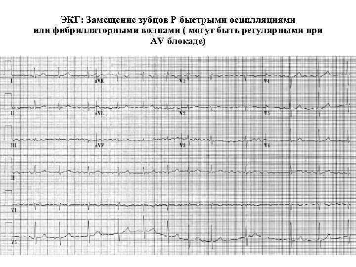 ЭКГ: Замещение зубцов Р быстрыми осцилляциями или фибрилляторными волнами ( могут быть регулярными при