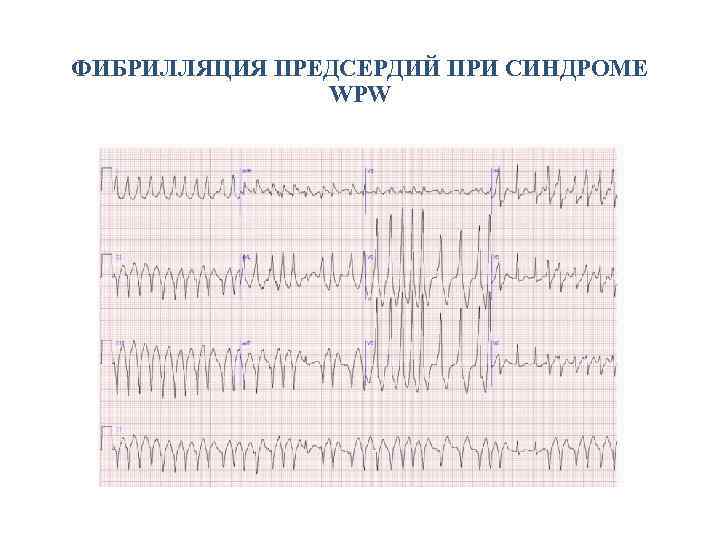 ФИБРИЛЛЯЦИЯ ПРЕДСЕРДИЙ ПРИ СИНДРОМЕ WPW 