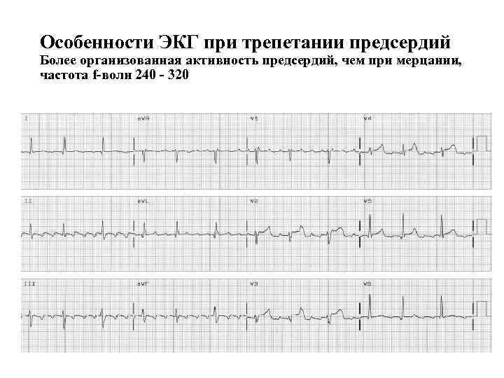 Трепетание предсердий карта вызова скорой медицинской помощи