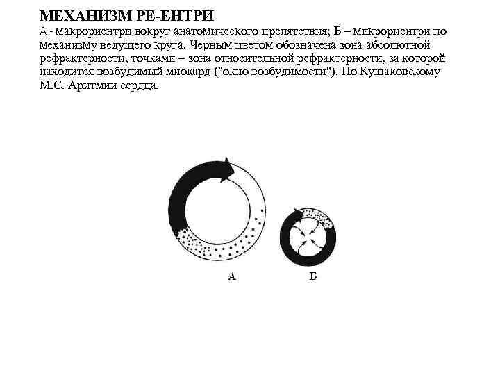 МЕХАНИЗМ РЕ-ЕНТРИ А - макрориентри вокруг анатомического препятствия; Б – микрориентри по механизму ведущего