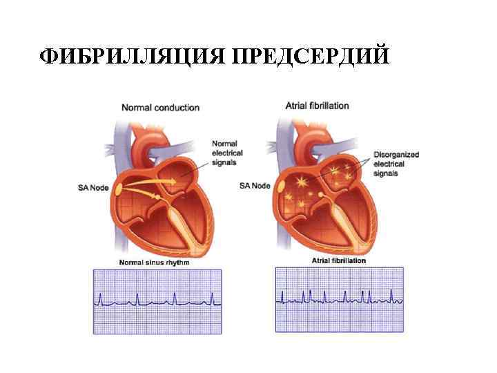 ФИБРИЛЛЯЦИЯ ПРЕДСЕРДИЙ 