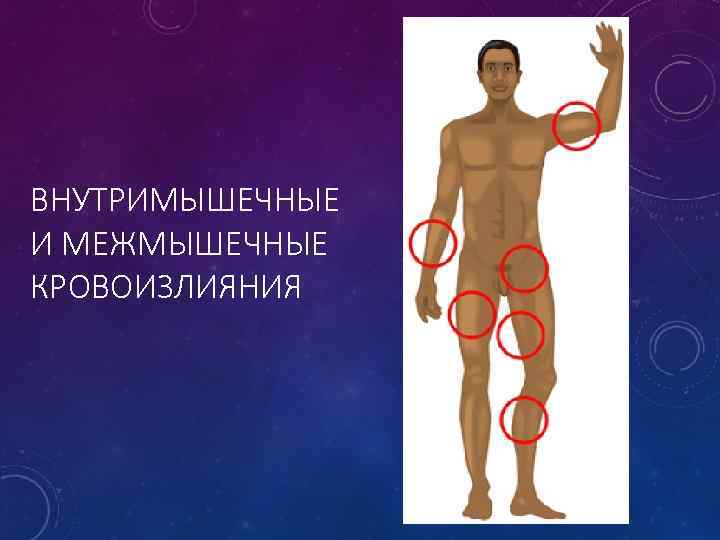ВНУТРИМЫШЕЧНЫЕ И МЕЖМЫШЕЧНЫЕ КРОВОИЗЛИЯНИЯ 