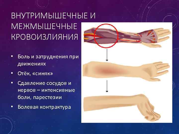 ВНУТРИМЫШЕЧНЫЕ И МЕЖМЫШЕЧНЫЕ КРОВОИЗЛИЯНИЯ • Боль и затруднения при движениях • Отёк, «синяк» •