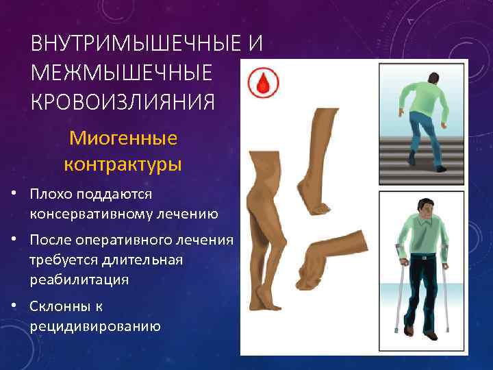 ВНУТРИМЫШЕЧНЫЕ И МЕЖМЫШЕЧНЫЕ КРОВОИЗЛИЯНИЯ Миогенные контрактуры • Плохо поддаются консервативному лечению • После оперативного