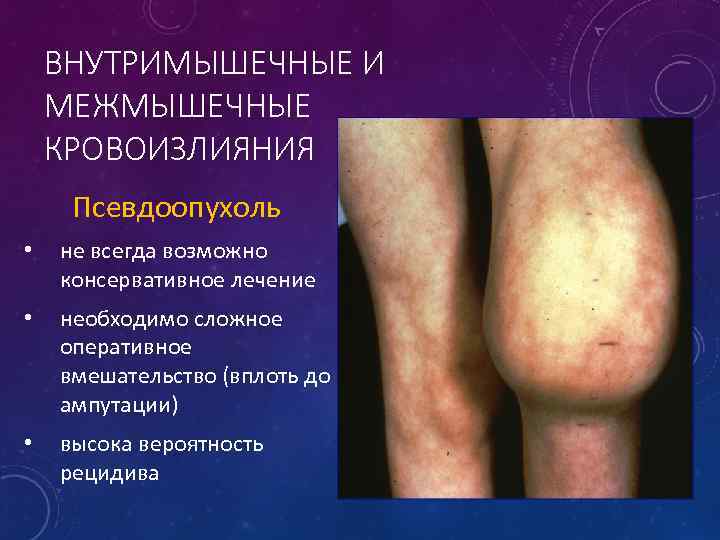 ВНУТРИМЫШЕЧНЫЕ И МЕЖМЫШЕЧНЫЕ КРОВОИЗЛИЯНИЯ Псевдоопухоль • не всегда возможно консервативное лечение • необходимо сложное