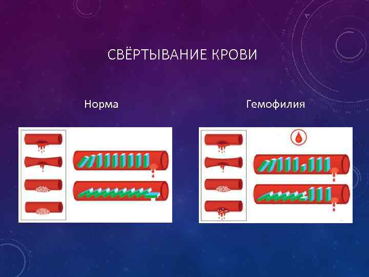 СВЁРТЫВАНИЕ КРОВИ Норма Гемофилия 
