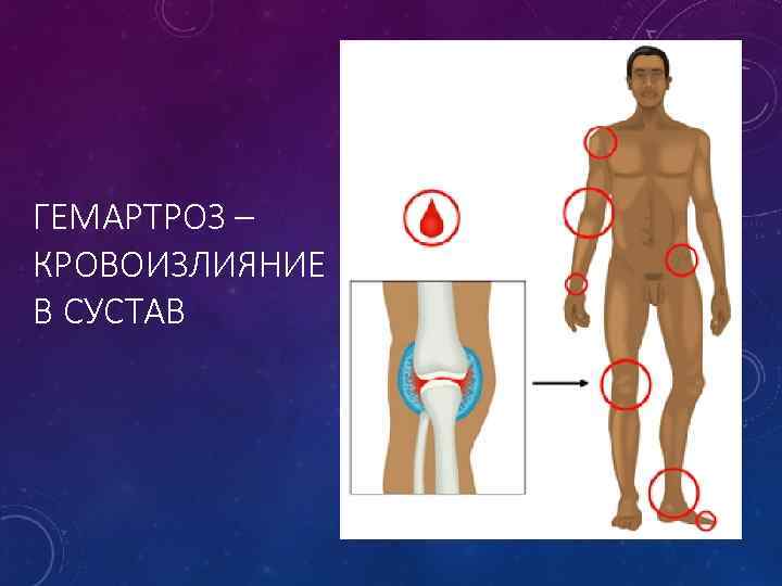 ГЕМАРТРОЗ – КРОВОИЗЛИЯНИЕ В СУСТАВ 