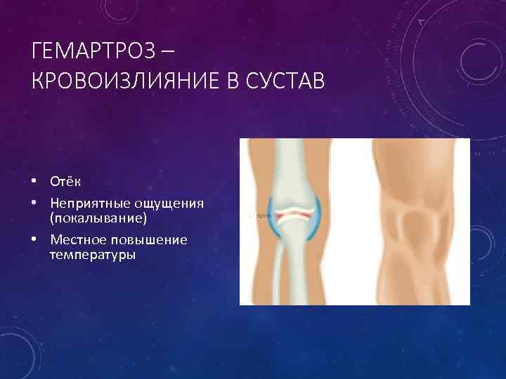 ГЕМАРТРОЗ – КРОВОИЗЛИЯНИЕ В СУСТАВ • Отёк • Неприятные ощущения (покалывание) • Местное повышение