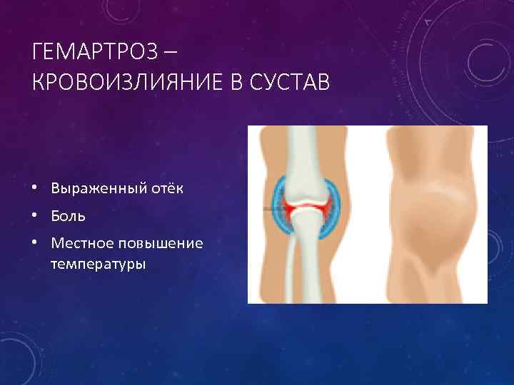ГЕМАРТРОЗ – КРОВОИЗЛИЯНИЕ В СУСТАВ • Выраженный отёк • Боль • Местное повышение температуры