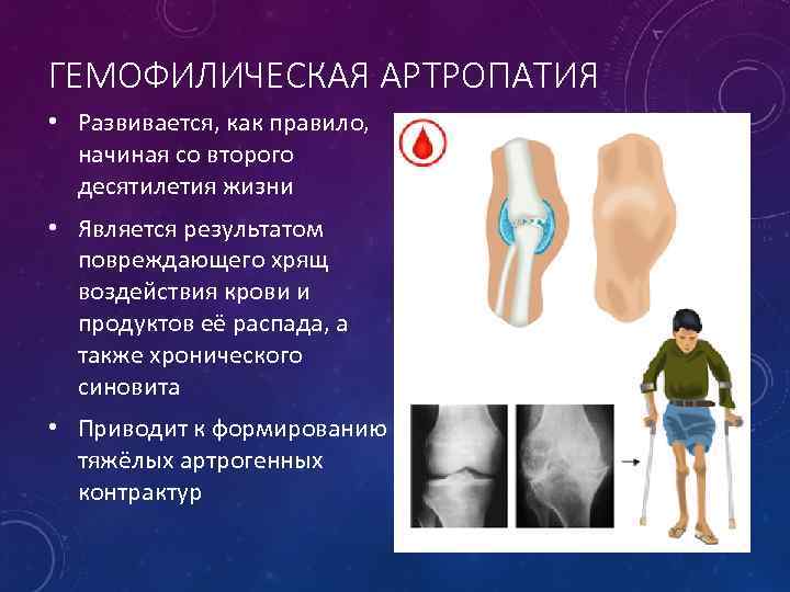 ГЕМОФИЛИЧЕСКАЯ АРТРОПАТИЯ • Развивается, как правило, начиная со второго десятилетия жизни • Является результатом