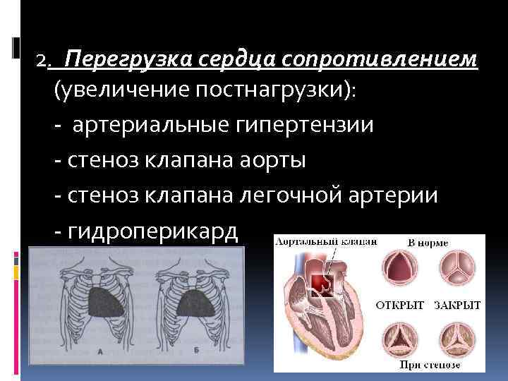 2. Перегрузка сердца сопротивлением (увеличение постнагрузки): - артериальные гипертензии - стеноз клапана аорты -