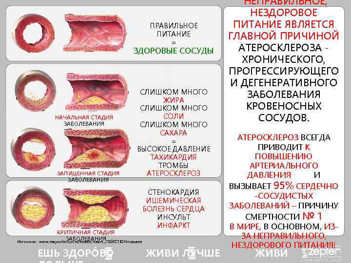 ПРАВИЛЬНОЕ ПИТАНИЕ = ЗДОРОВЫЕ СОСУДЫ НАЧАЛЬНАЯ СТАДИЯ ЗАБОЛЕВАНИЯ ЗАПУЩЕННАЯ СТАДИЯ ЗАБОЛЕВАНИЯ Источник: СЛИШКОМ МНОГО