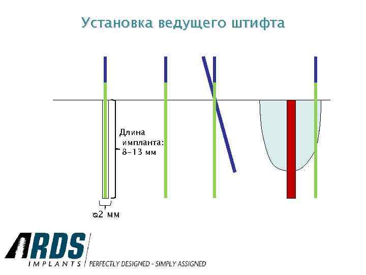 Установка ведущего штифта Длина импланта: 8 -13 мм ᴓ 2 мм 