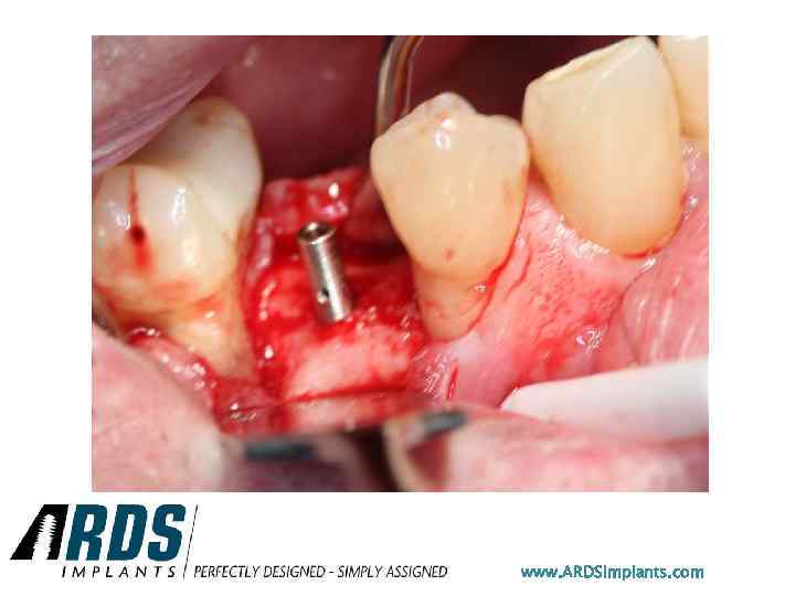 www. ARDSimplants. com 