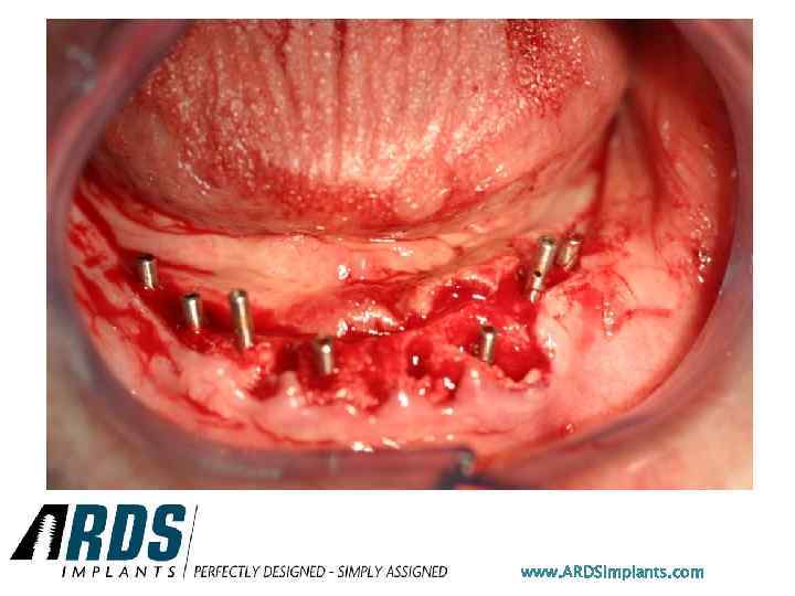 www. ARDSimplants. com 