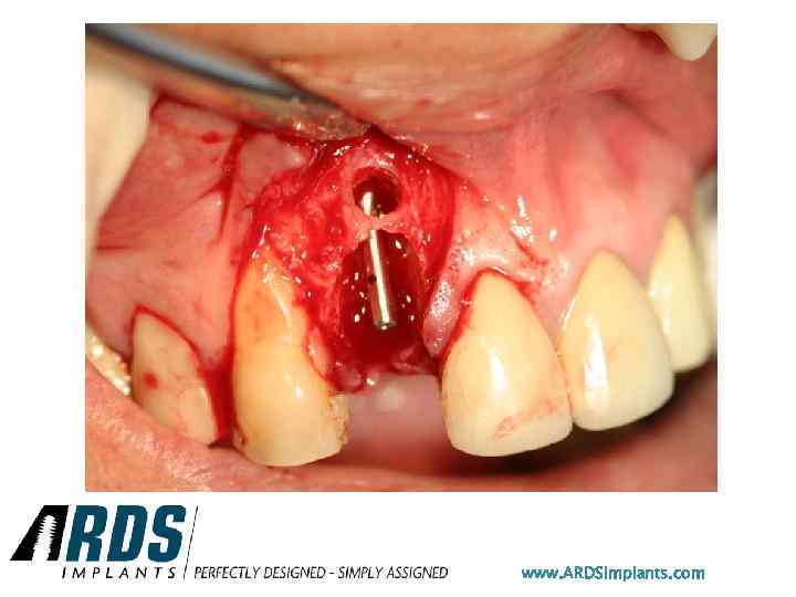 www. ARDSimplants. com 