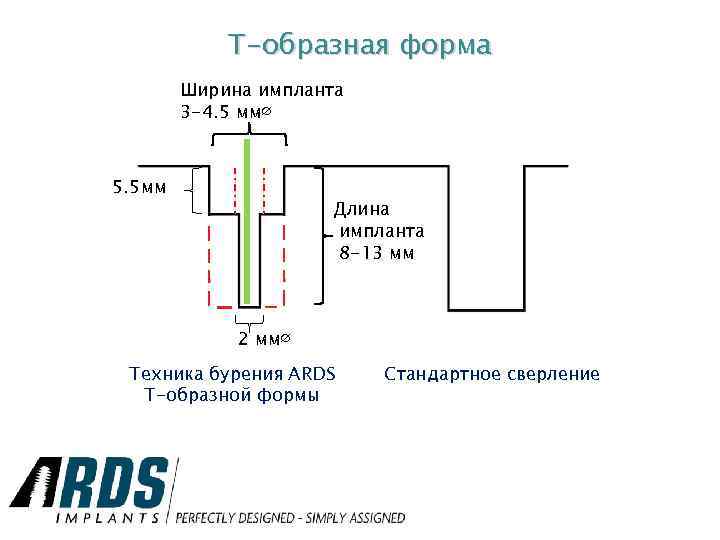 Т-образная форма Ширина импланта 3 -4. 5 мм∅ 5. 5 мм Длина импланта 8