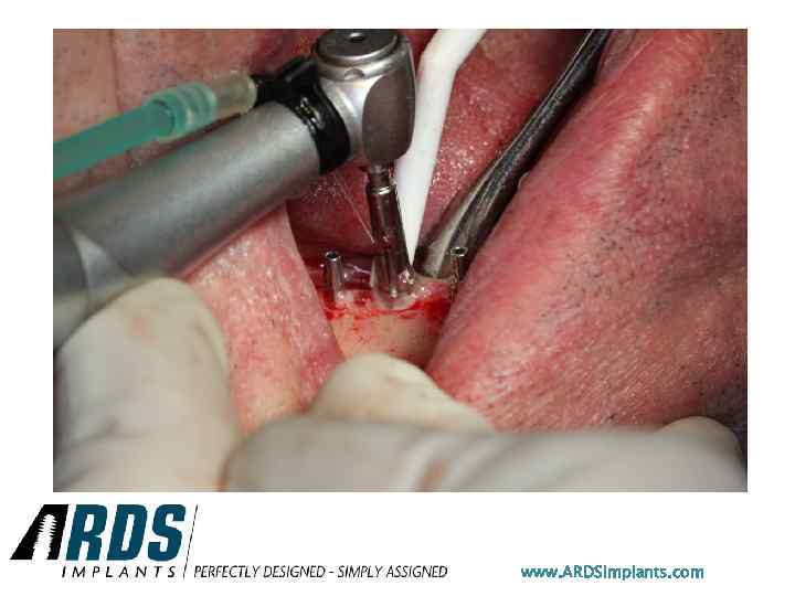 www. ARDSimplants. com 