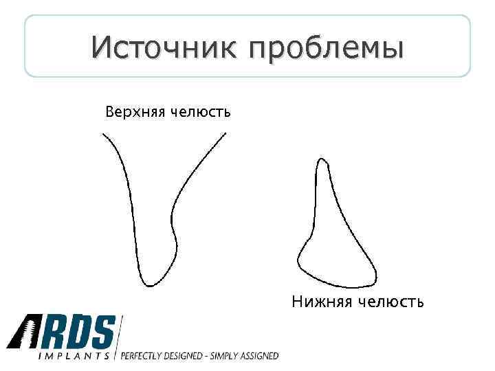 Источник проблемы Верхняя челюсть Нижняя челюсть 