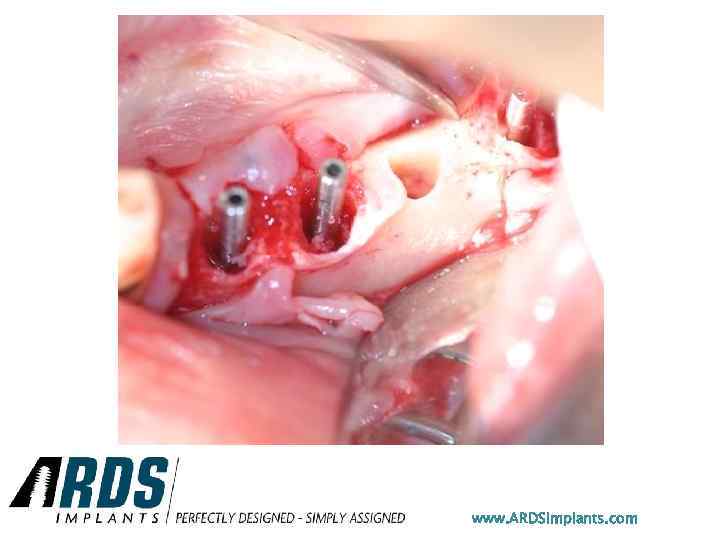 www. ARDSimplants. com 