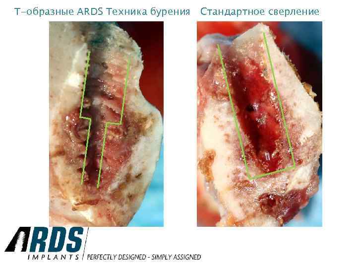 Т-образные ARDS Техника бурения Стандартное сверление 