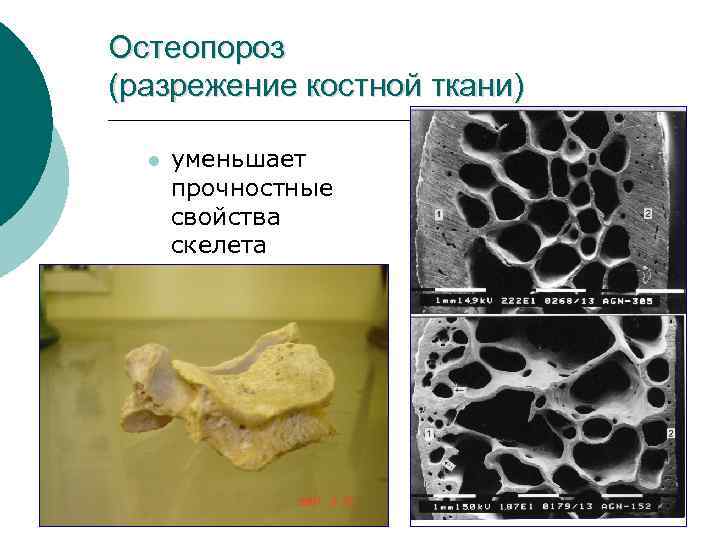 Остеопороз (разрежение костной ткани) l уменьшает прочностные свойства скелета 