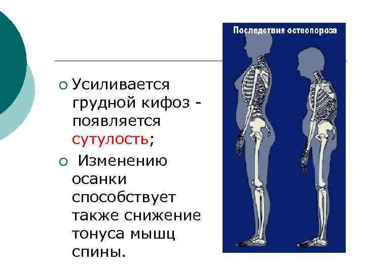 Усиливается грудной кифоз появляется сутулость; ¡ Изменению осанки способствует также снижение тонуса мышц спины.