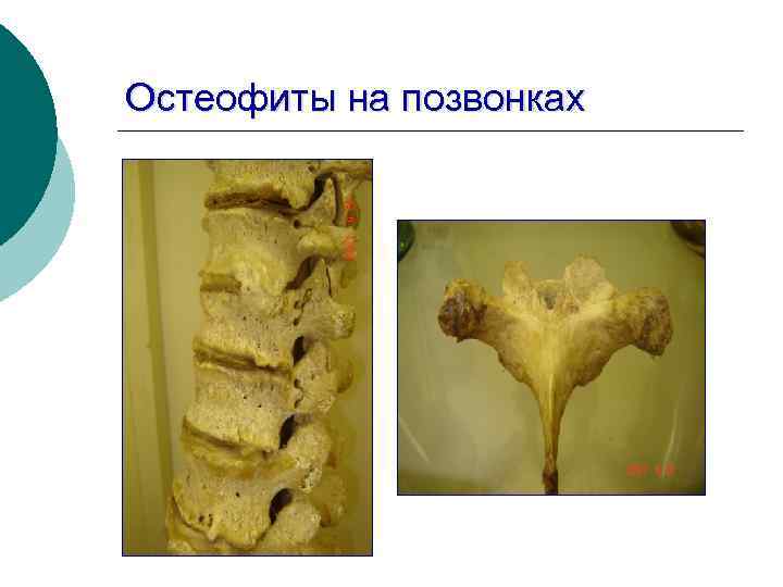 Остеофиты на позвонках 