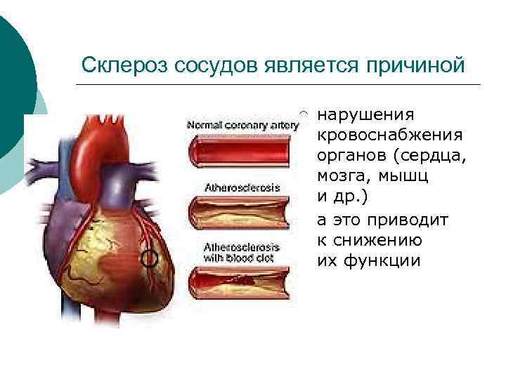 Склероз сосудов является причиной ¡ ¡ нарушения кровоснабжения органов (сердца, мозга, мышц и др.