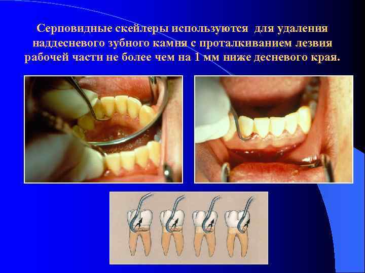 Серповидные скейлеры используются для удаления наддесневого зубного камня с проталкиванием лезвия рабочей части не