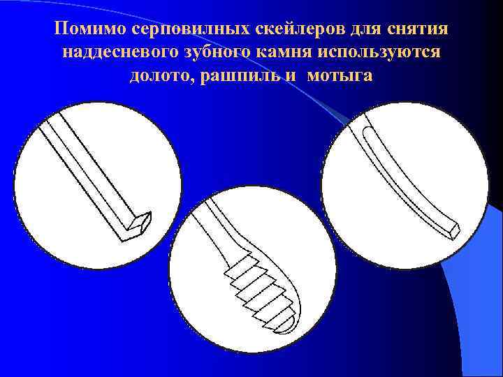 Помимо серповилных скейлеров для снятия наддесневого зубного камня используются долото, рашпиль и мотыга 