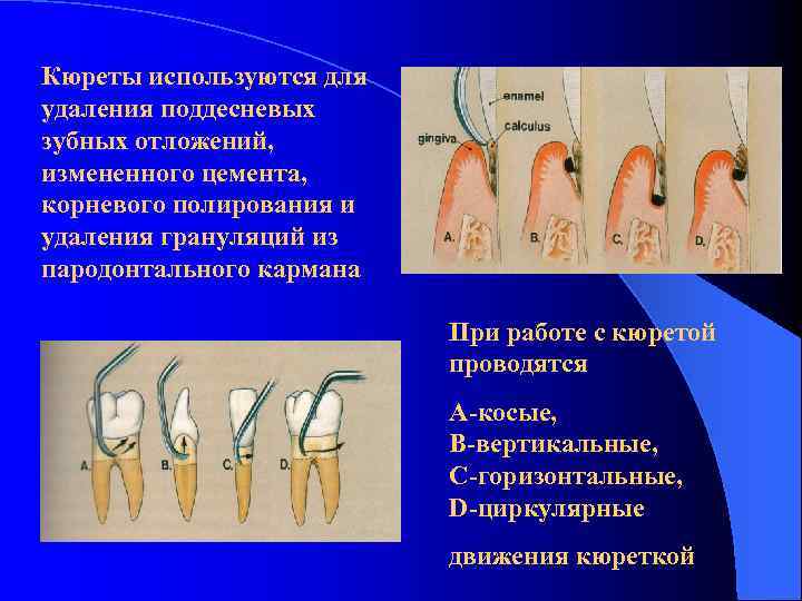 Кюреты используются для удаления поддесневых зубных отложений, измененного цемента, корневого полирования и удаления грануляций