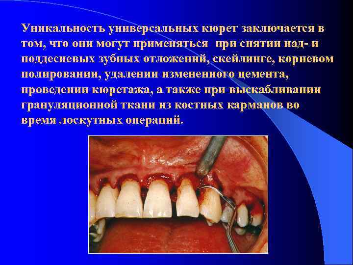 Уникальность универсальных кюрет заключается в том, что они могут применяться при снятии над- и