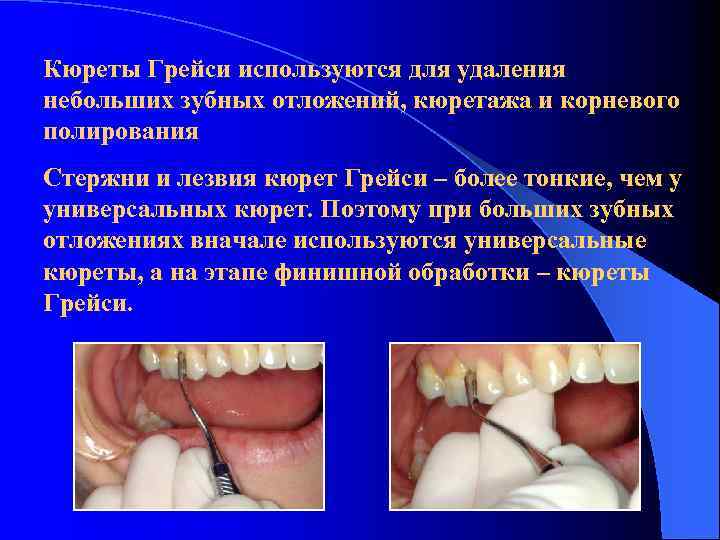 Кюреты Грейси используются для удаления небольших зубных отложений, кюретажа и корневого полирования Стержни и