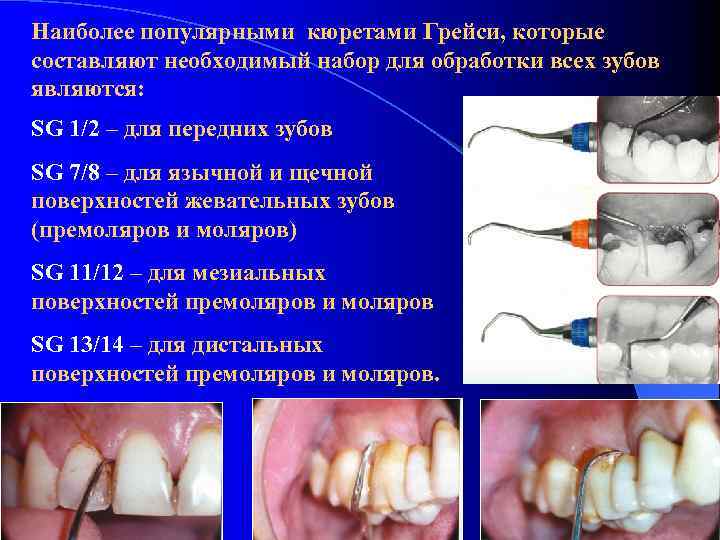 Наиболее популярными кюретами Грейси, которые составляют необходимый набор для обработки всех зубов являются: SG