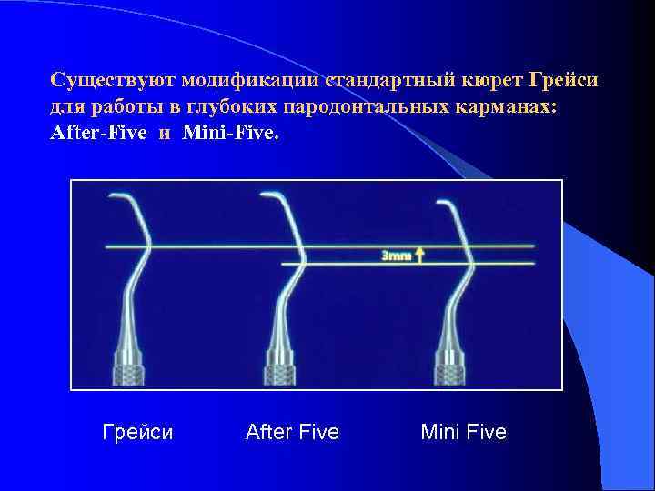 Существуют модификации стандартный кюрет Грейси для работы в глубоких пародонтальных карманах: After-Five и Mini-Five.