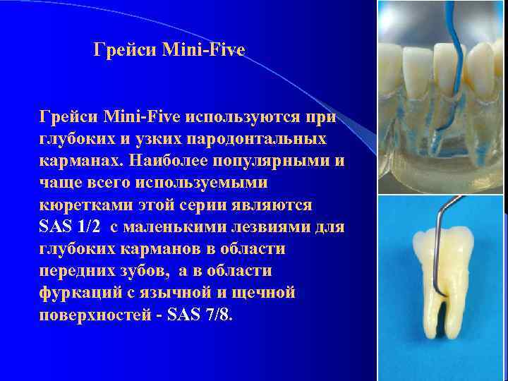 Грейси Mini-Five используются при глубоких и узких пародонтальных карманах. Наиболее популярными и чаще всего