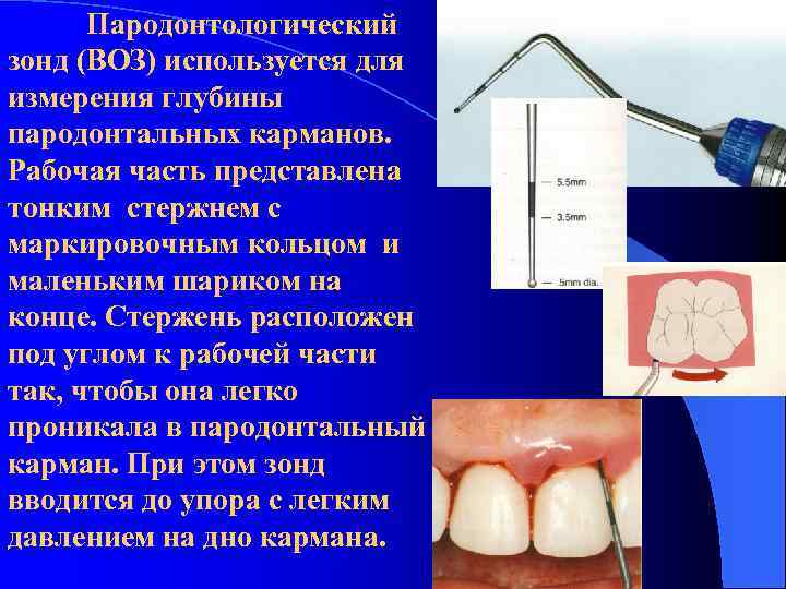 Пародонтологический зонд (ВОЗ) используется для измерения глубины пародонтальных карманов. Рабочая часть представлена тонким стержнем