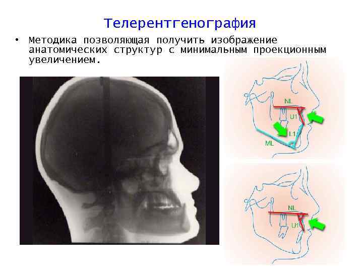 Телерентгенография • Методика позволяющая получить изображение анатомических структур с минимальным проекционным увеличением. 