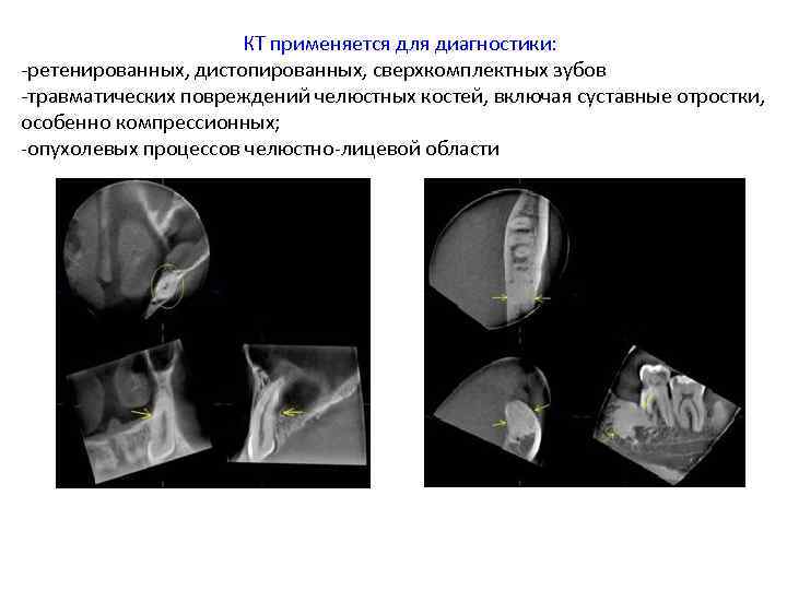 КТ применяется для диагностики: -ретенированных, дистопированных, сверхкомплектных зубов -травматических повреждений челюстных костей, включая суставные