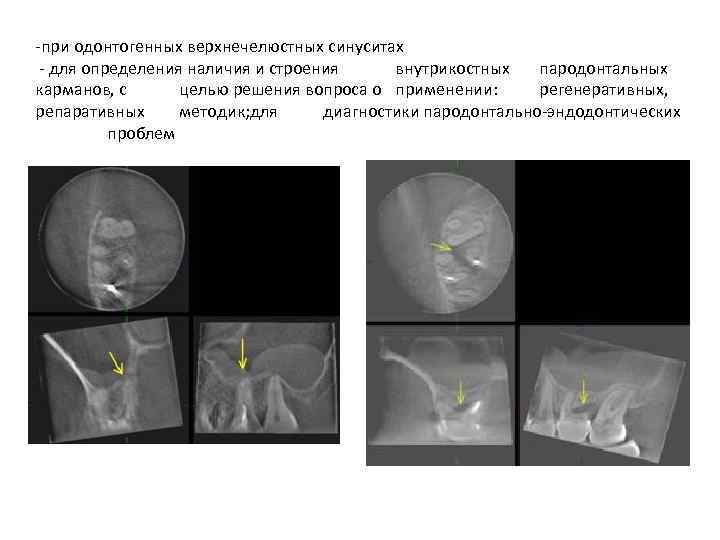 -при одонтогенных верхнечелюстных синуситах - для определения наличия и строения внутрикостных пародонтальных карманов, с