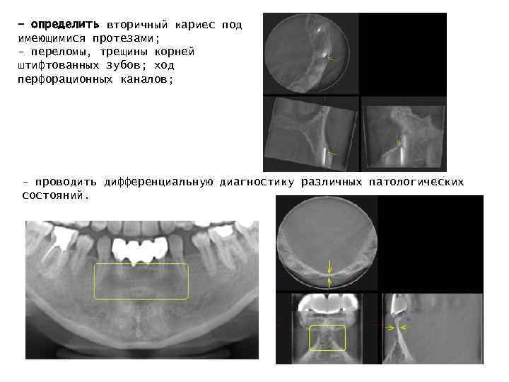 - определить вторичный кариес под имеющимися протезами; - переломы, трещины корней штифтованных зубов; ход