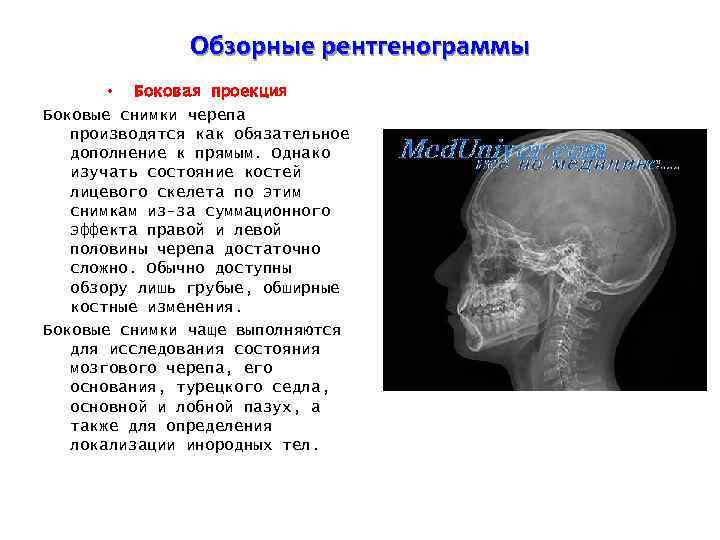 Обзорные рентгенограммы • Боковая проекция Боковые снимки черепа производятся как обязательное дополнение к прямым.