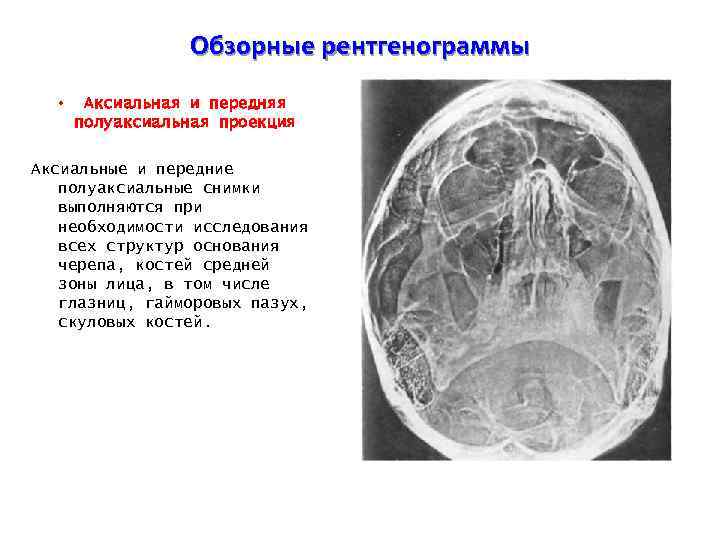 Проекции рентгена. Полуаксиальная проекция верхней челюсти. Аксиальная проекция рентген. Аксиальная проекция черепа рентгенограмма. Снимок черепа в аксиальной проекции.