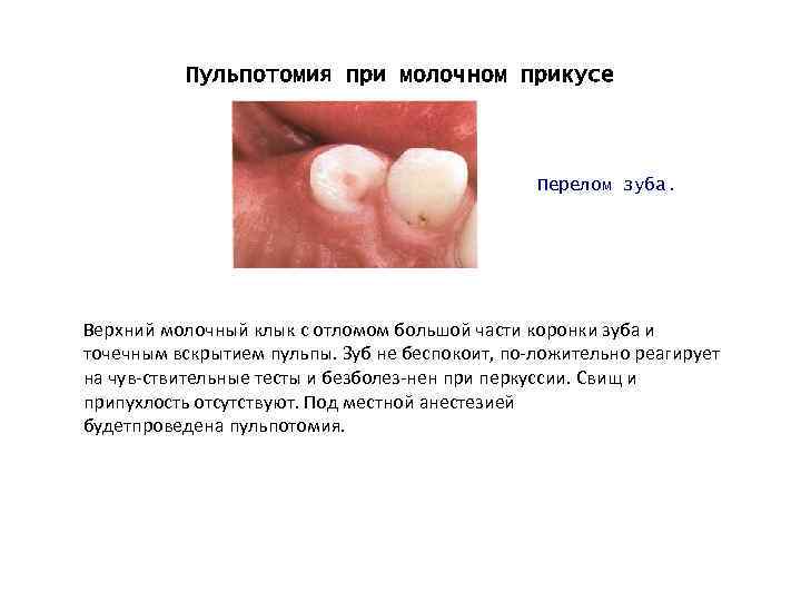 Пульпотомия при молочном прикусе Перелом зуба. Верхний молочный клык с отломом большой части коронки