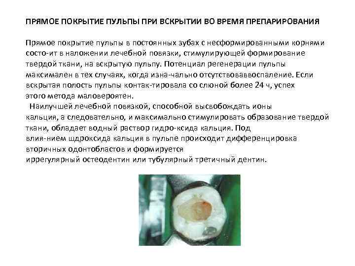 ПРЯМОЕ ПОКРЫТИЕ ПУЛЬПЫ ПРИ ВСКРЫТИИ ВО ВРЕМЯ ПРЕПАРИРОВАНИЯ Прямое покрытие пульпы в постоянных зубах