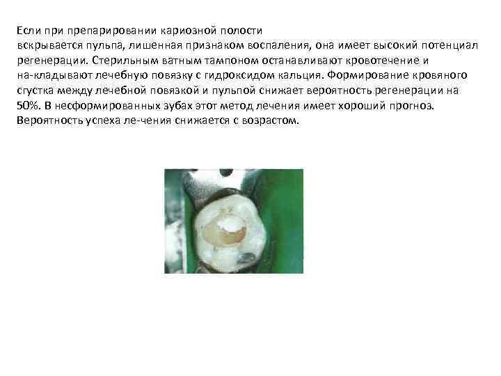 Если препарировании кариозной полости вскрывается пульпа, лишенная признаком воспаления, она имеет высокий потенциал регенерации.