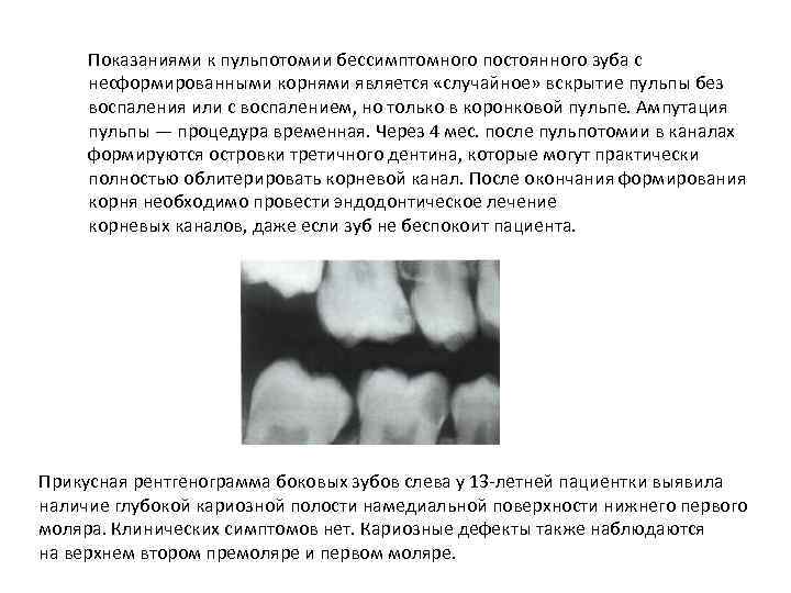 Показаниями к пульпотомии бессимптомного постоянного зуба с несформированными корнями является «случайное» вскрытие пульпы без